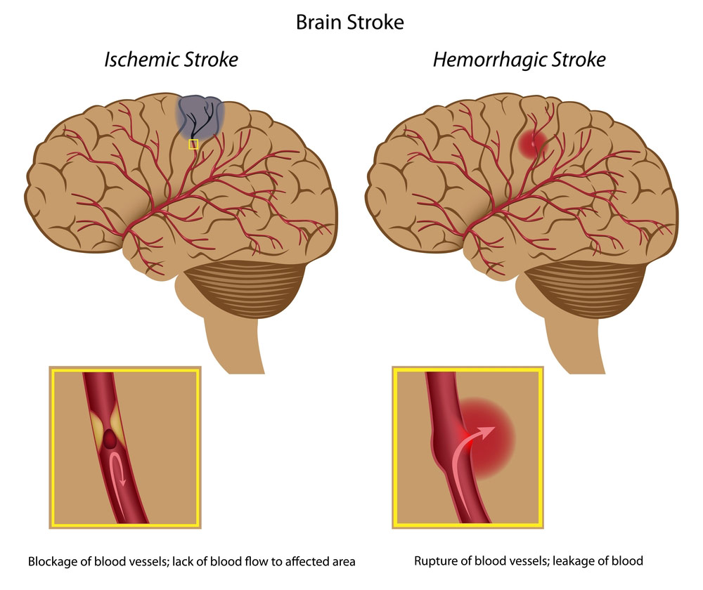 Types-of-Stroke.jpg